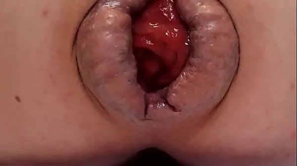 Contender For Biggest Prolapse (Male Warning!)